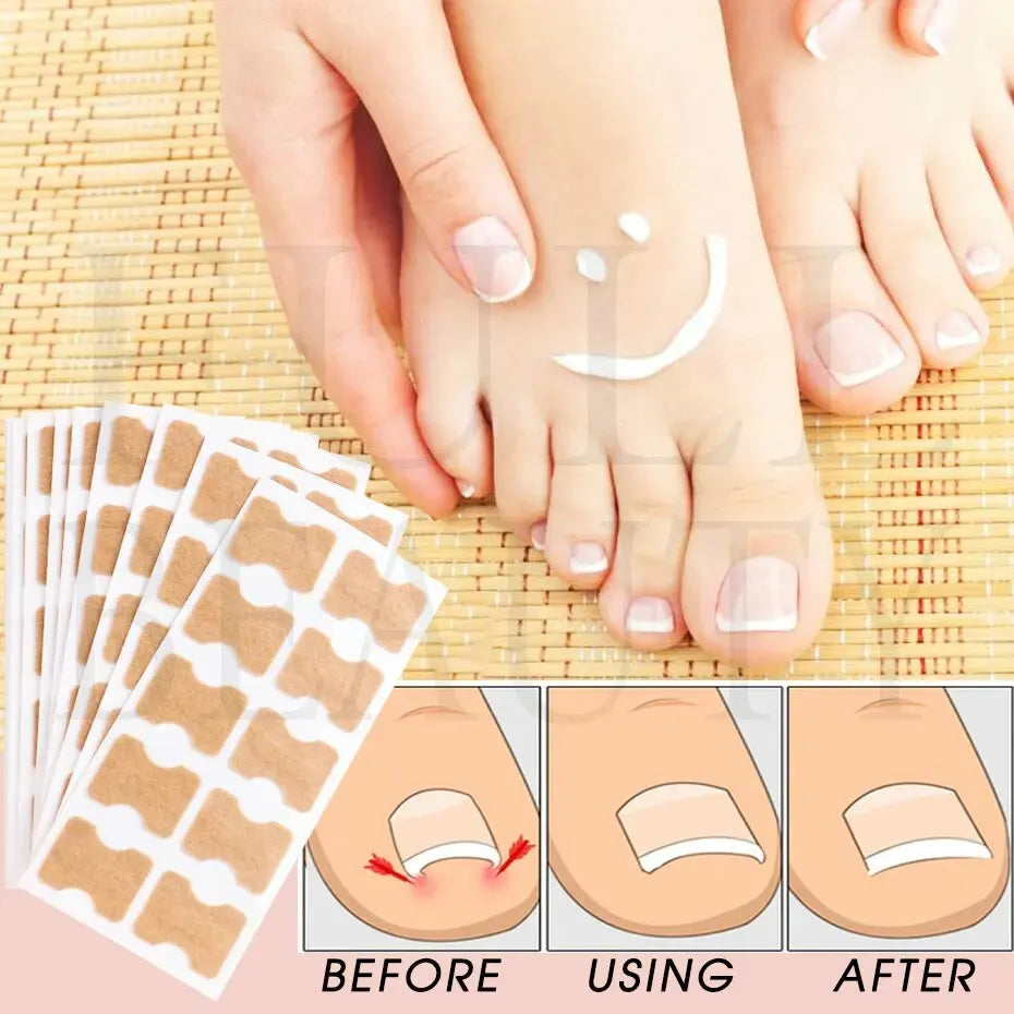 Ingrown Toenail Correction Sticker Adhesive Toenail Patch Elastic Nail Treatment Corrector Sticker Foot Care Tools