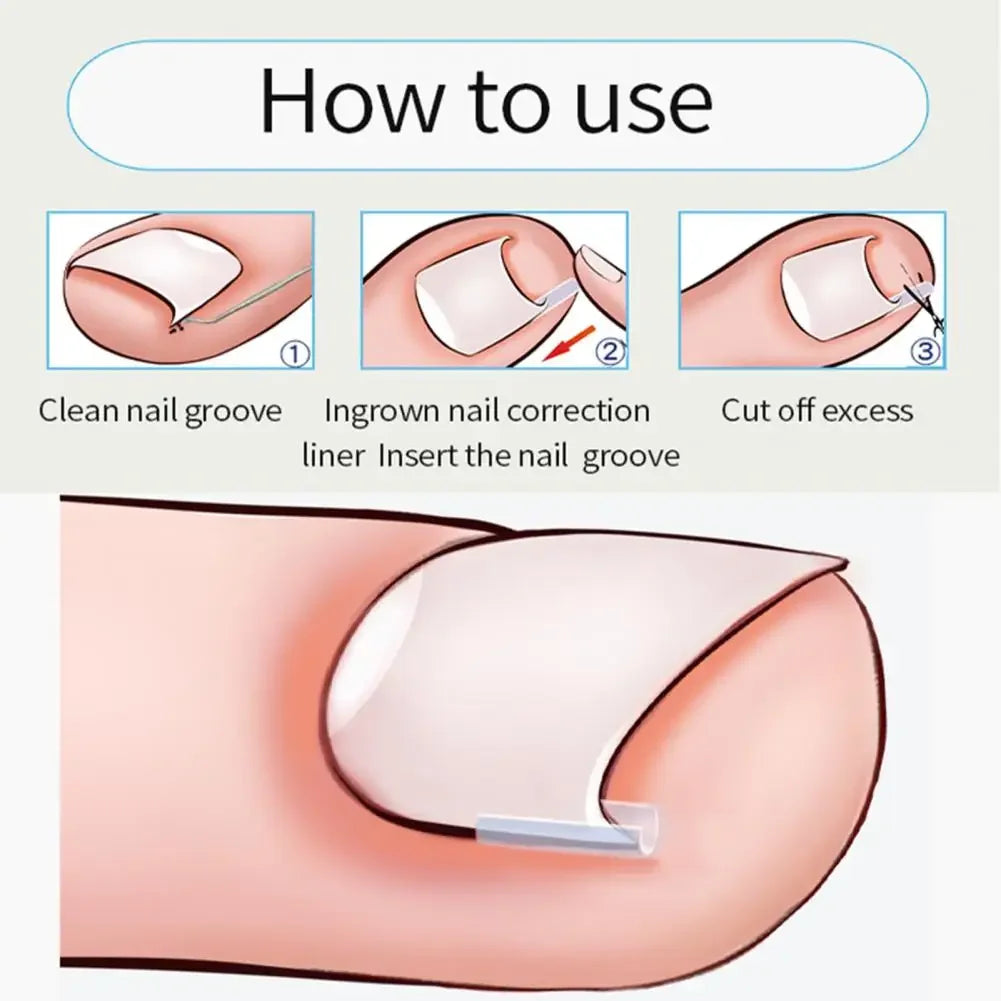 Ingrown Toenail Corrector Patch – Ultra-Thin Nail Treatment Stickers for Pain Relief, Straightening, and Groove Support