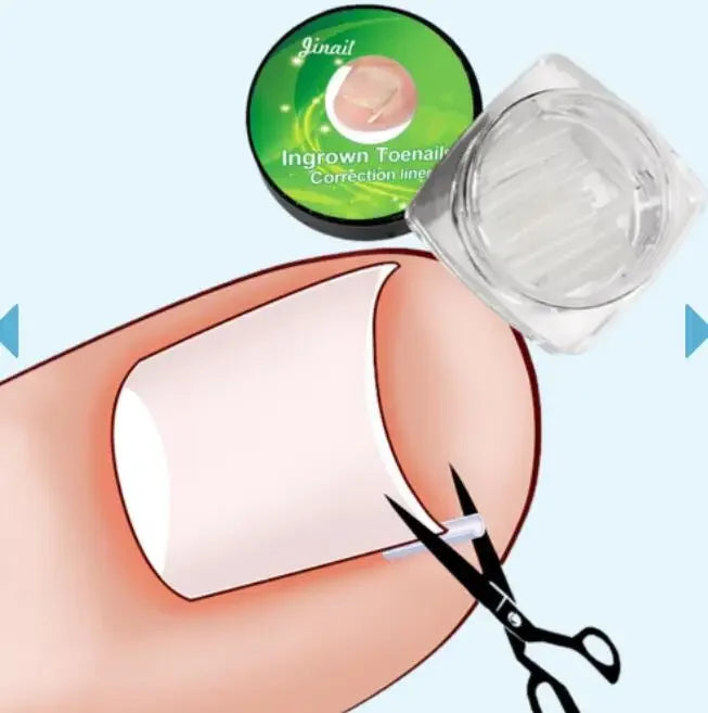 Ingrown Toenail Corrector Patch – Ultra-Thin Nail Treatment Stickers for Pain Relief, Straightening, and Groove Support