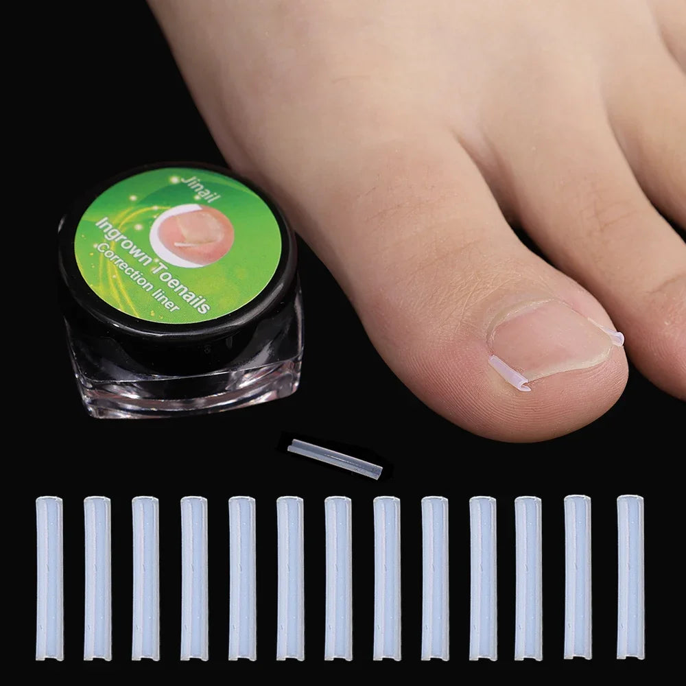 Ingrown Toenail Corrector Patch – Ultra-Thin Nail Treatment Stickers for Pain Relief, Straightening, and Groove Support