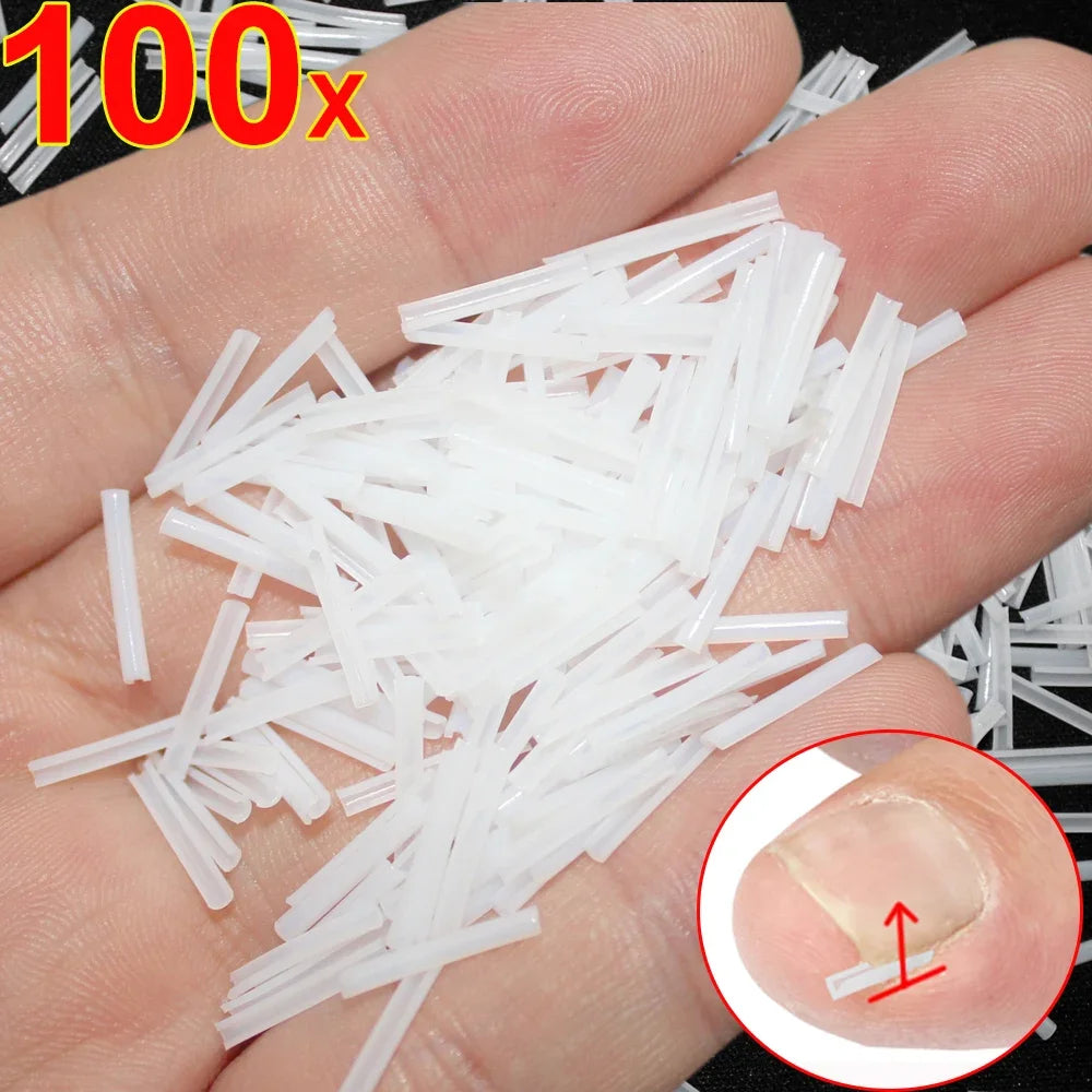 Ingrown Toenail Corrector Patch – Ultra-Thin Nail Treatment Stickers for Pain Relief, Straightening, and Groove Support