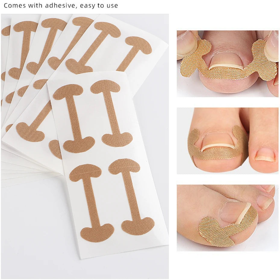 Ingrown Toenail Correction Sticker Adhesive Toenail Patch Elastic Nail Treatment Corrector Sticker Foot Care Tools